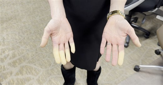 Managing Raynaud’s Syndrome: What to do when fingers turn white