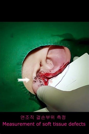 귀 결손 재건 reconstruction of auricular defects