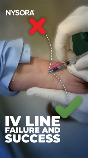 IV Failure: What to do next? 🎬 In this reel, we demonstrate an IV failure and a fix! IV insertion is a skill that requires precision, practice, and patience. To see tips in action, check the full video on the NYSORA YouTube channel! #nysora #ivinsertion | NYSORA - Continuing Medical Education