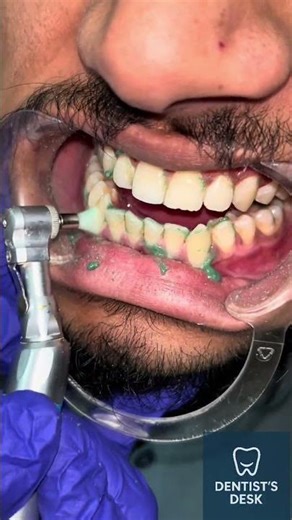 Tooth Polishing Procedure ASMR #asmr #asmrsounds #satisfying #dentist