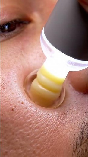 Extreme macro shot of inflamed pimples and blackheads on unclean skin