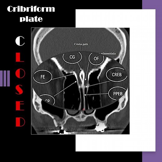 Nose radiology series (1): The cribriform plate (1) #shorts
