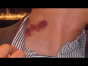 HOW TO GIVE A HICKEY FAST AND EASY