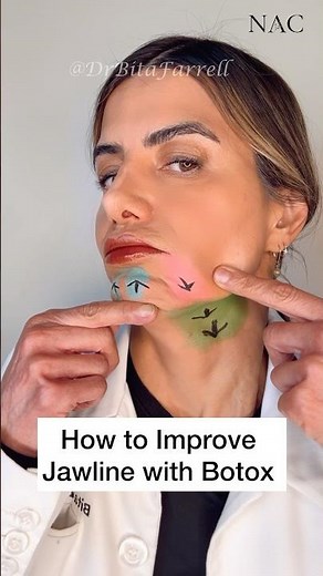 Botox to depressor muscles allows elevators to dominate. Patreon.com/drbitafarrell #drbitafarrell