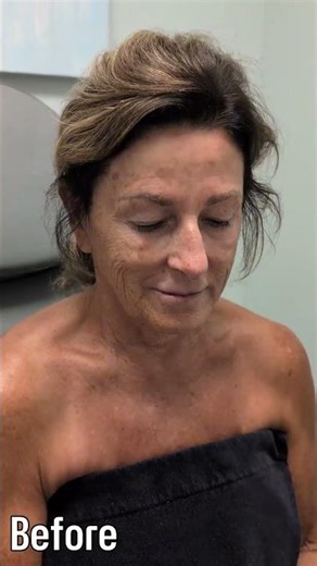 2 months post-op after a CURRENT Lift