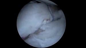 Arthroscopic Glenoid Fracture Repair (Bony Bankart Repair)