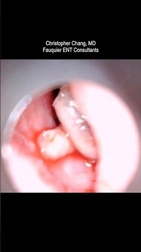MAGGOTS in the Ear Canal (Myiasis)