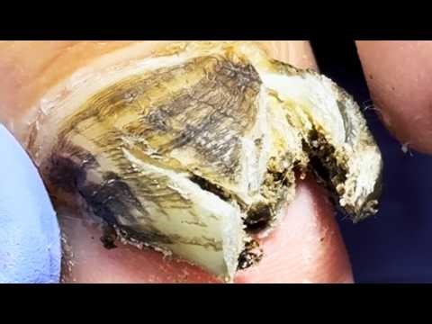 Super Black Toenails, Like A Hard Black Stone【Dr Liu's Pedicur】