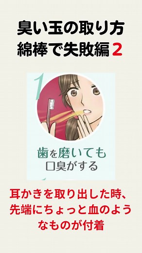 臭い玉の取り方！綿棒で失敗編２ #臭い玉 #臭い玉の取り方 #膿栓 #膿栓除去 #ルブレン #いいの製薬