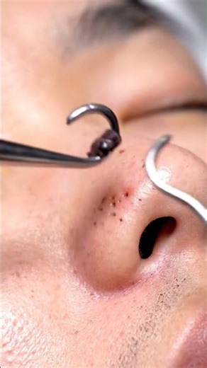 Blackhead Removal Transformation