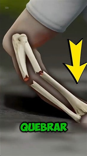SE VOCÊ QUEBRAR O BRAÇO , ISSO ACONTECE