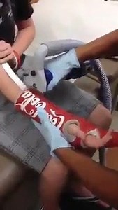 Getting Cast off.... Look at how tiny his arm got | INCelebrities