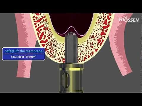 OSSTEM / HIOSSEN CAS-Kit (Crestal Approach Sinus Kit)