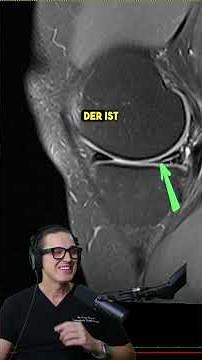 A look inside the knee thanks to MRI (including a classic meniscus tear)