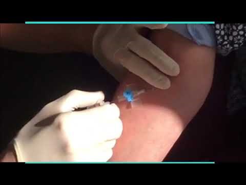 cannulation Technique in ACF