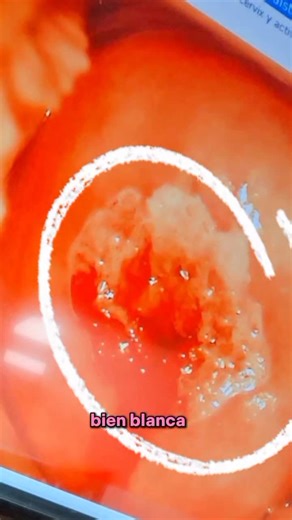 La Importancia de la Colposcopia en la Salud Femenina