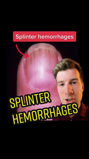 Splinter hemorrhages … what heart condition is classically associated with this clinical sign? #splinterhemorrhage #heart #cardiology #medicine #doctor #clinicalmedicine #usmle #nurse #physicianassistant #endocarditis #raynaudssyndrome #hearthealth #infection #infectiousdisease #meded #medicaleducation #nursingstudent #medstudent #medical #medicaltiktok #doctorsoftiktok #nursingtips #medicalfacts #fyp #foryoupage