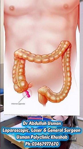 Symptoms of Acute Appendicitis