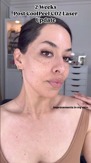 2 Weeks After Cool Peel CO2 Laser Treatment 🙌 Already noticing a difference! #coolpeelco2#coolpeel