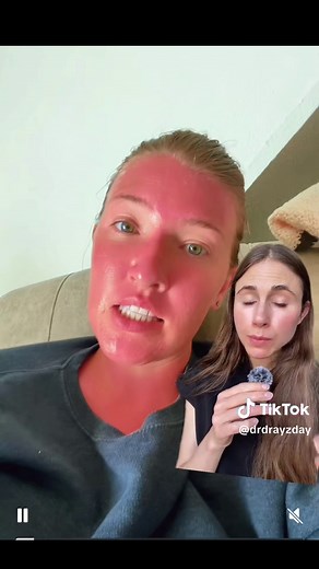 How to heal a sunburn #sunburn #sunburnrelief #sunburnt #dermatologist @_haleighbree