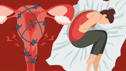 What It Feels Like To Have Endometriosis