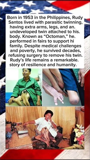 Rudy Santos: The “Octoman” Who Defied All Odds #viral #story #facts #trending