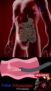 Coloscopy Colon Polyp Resection Polypectomy #shorts #reesl #facbookReelscontest #doctor #DoctorWho #doctorsofinstagram #documentaryphotography | SMART Doctor