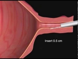Macroplastique® Urethral Bulking for Female Stress Urinary Incontinence