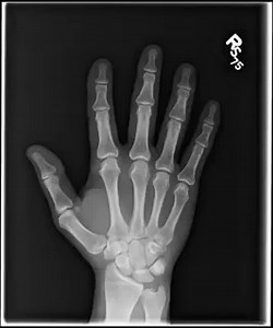 X-ray Sunday Triquetral Fracture | CTisus: Cutting edge information on body CT (Computed tomography). | Facebook