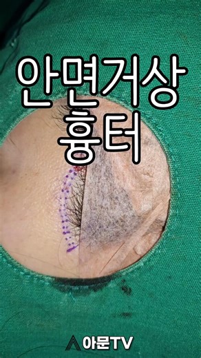 안면거상 수술 흉터, 개선 방법은? (주사 레이저 수술)[아문TV]