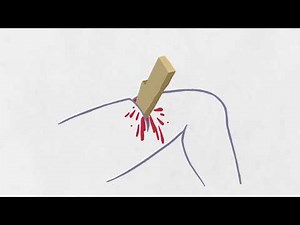 How To Deal With Severe Bleeding