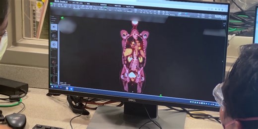 Medical Moment: Using AI to detect lung cancer early