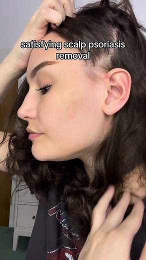 Satisfying Psoriasis Scalp Removal | Scalp Psoriasis Patches Removal