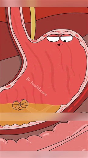 CUIDADO: O Balão de Emagrecer que pode Bloquear seu Intestino