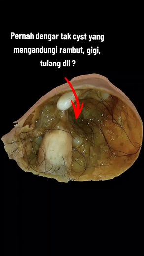 Apa Itu Dermoid Cyst? Penjelasan dan Gejala