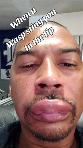 Wasp Sting Reaction: Quick Swelling Story