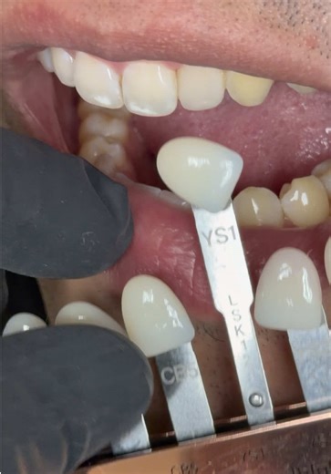 Quick and Easy Shade Matching with Chairside Shade Guide 8.0