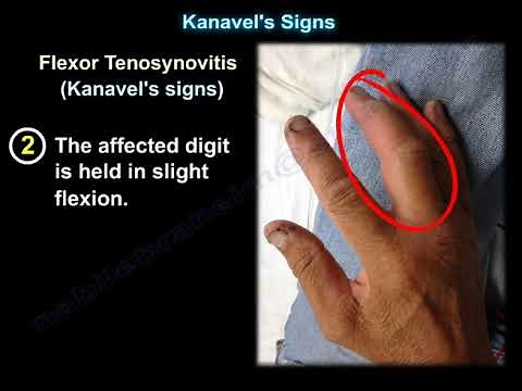 Kanavel's Signs, infection of the flexor tendons