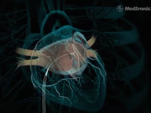 三维医疗动画案例 #三维动画 #3D动画 #医疗动画 #动画制作