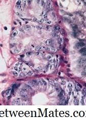 Diferença entre Displasia e Metaplasia Diferença entre - Outras 2026