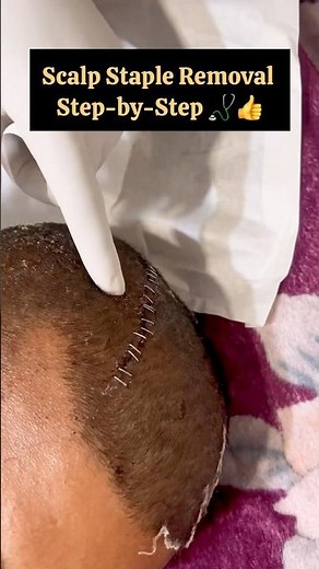 Scalp Staple Removal Step-by-Step👍✂️#ScalpStapleRemoval#nursing #youtubeshorts #trending