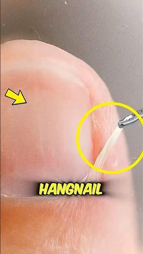 Stop Pulling Hangnails—Here’s What Really Happens #viral