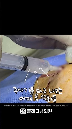 어깨 석회분쇄흡입술 vs 충격파｜언제 이 치료가 필요할까?