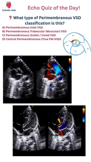 EchoDx Hub 🫀 on Instagram: "❓ What type of Perimembranous VSD classification is this? A) Perimembranous Inlet VSD B) Perimembranous Trabecular (Muscular) VSD C) Perimembranous Outlet / Conal VSD D) Central Perimembranous (True PM-VSD) #EchoDxHub #VSD #PerimembranousVSD #CHD #CardiologyQuiz #EchoMCQ #Echocardiography #CardiacImaging #PediatricCardiology #LearnEcho #CardiologyCases"