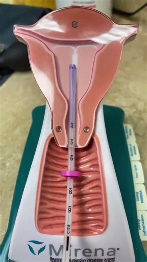 IUD insert #iud #iudinsertion #mirena #birthcontrol #obgyn #gynecology