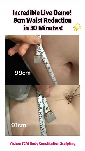Incredible Live Demo! 8cm Waist Reduction in 30 Minutes! A postpartum mother came to class with: • Abdominal muscle separation • Breast nodules (right chest) • Digestive stagnation and bloating 🩺 Pulse and tongue diagnosis showed Qi deficiency, spleen-stomach disharmony, and fascial weakness. During the live demo, Dr. Yichen performed: 1️⃣ Bagua Navel Acupuncture (Tonifying Method) — to restore organ balance and replenish Qi & Blood. 2️⃣ Breath-guided fascia training with needles retained — to 