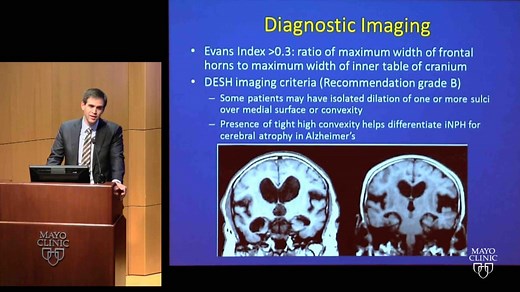 Adult-onset hydrocephalus - Mayo Clinic