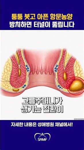 Can an Anal Abscess Lead to a Fistula? Why You Need to Check Swollen, Painful Anal Pus Immediatel...