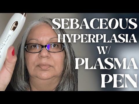 Successful Sebaceous Hyperplasia removal at-home - Customer Testimonial - Snow Skin Co