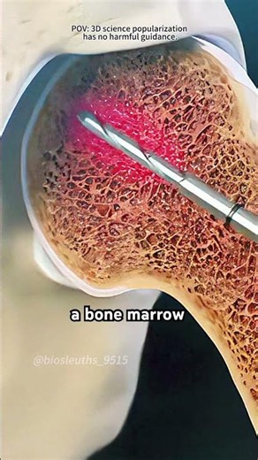 How Bone Marrow Biopsy Is Performed? (3D Animation)